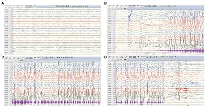 Anti-LGI1 encephalitis with initiating symptom of seizures in children